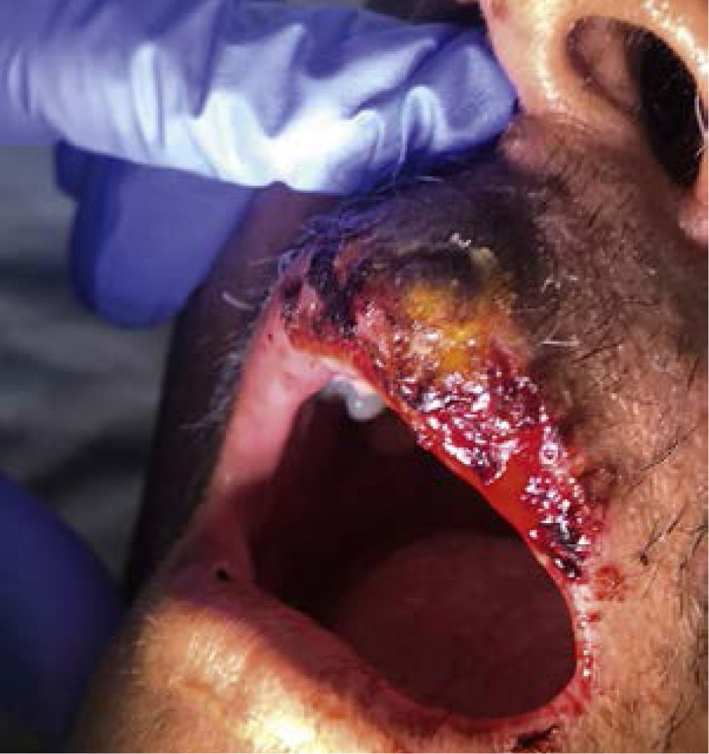 Recognizing a Skin Abscess: Symptoms, Causes & When to Seek Help